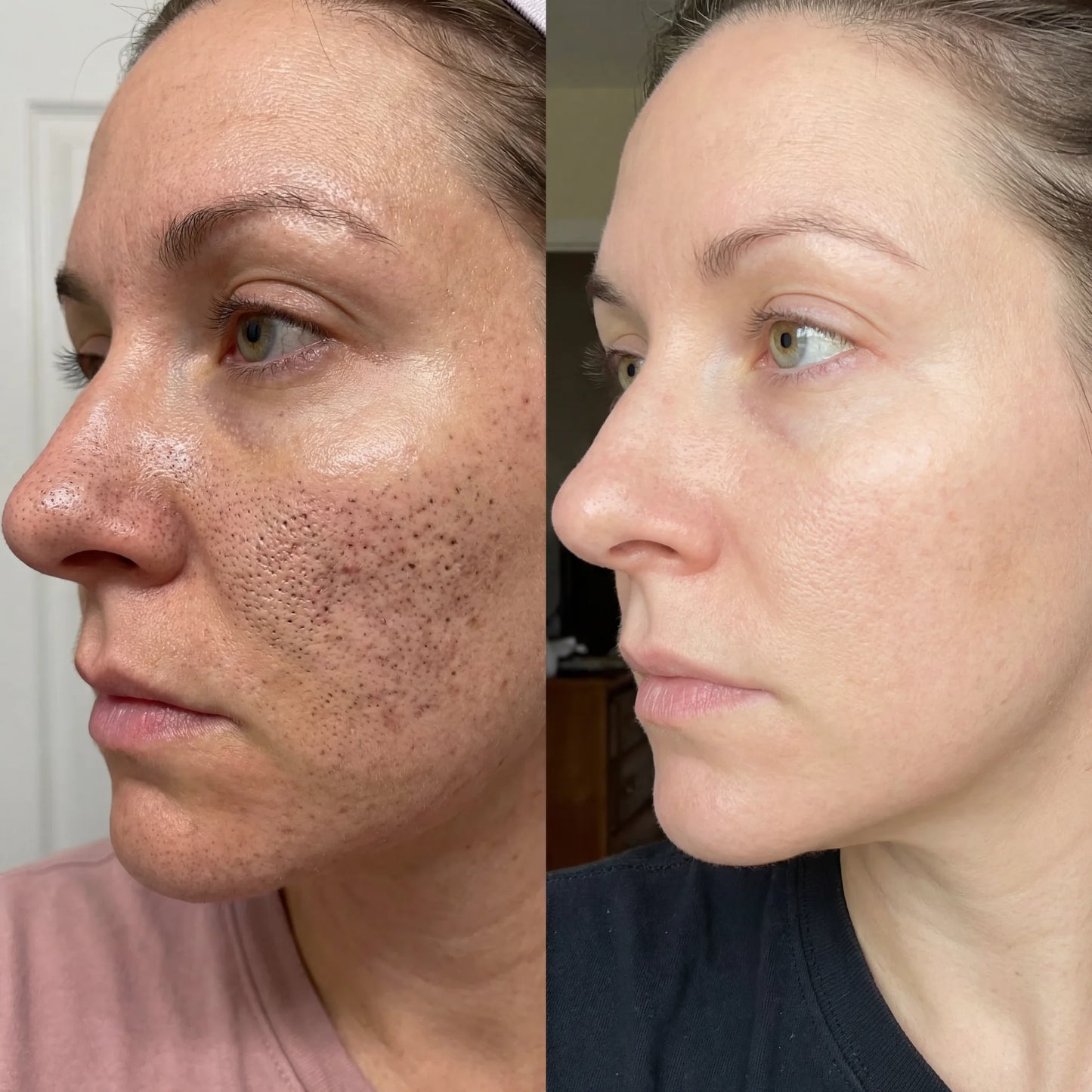 CollaPeel™ - Anti-Wrinkle, Acne Firming Mask