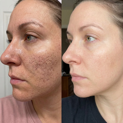 CollaPeel™ - Anti-Wrinkle, Acne Firming Mask