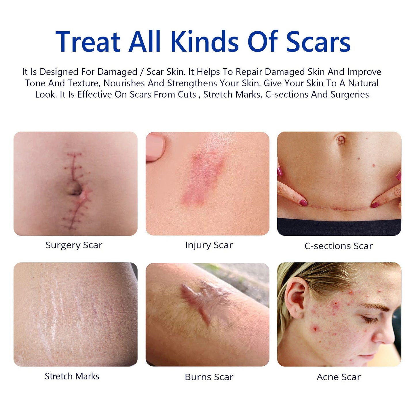SCAR REMOVAL CREAM
