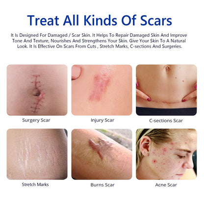 SCAR REMOVAL CREAM